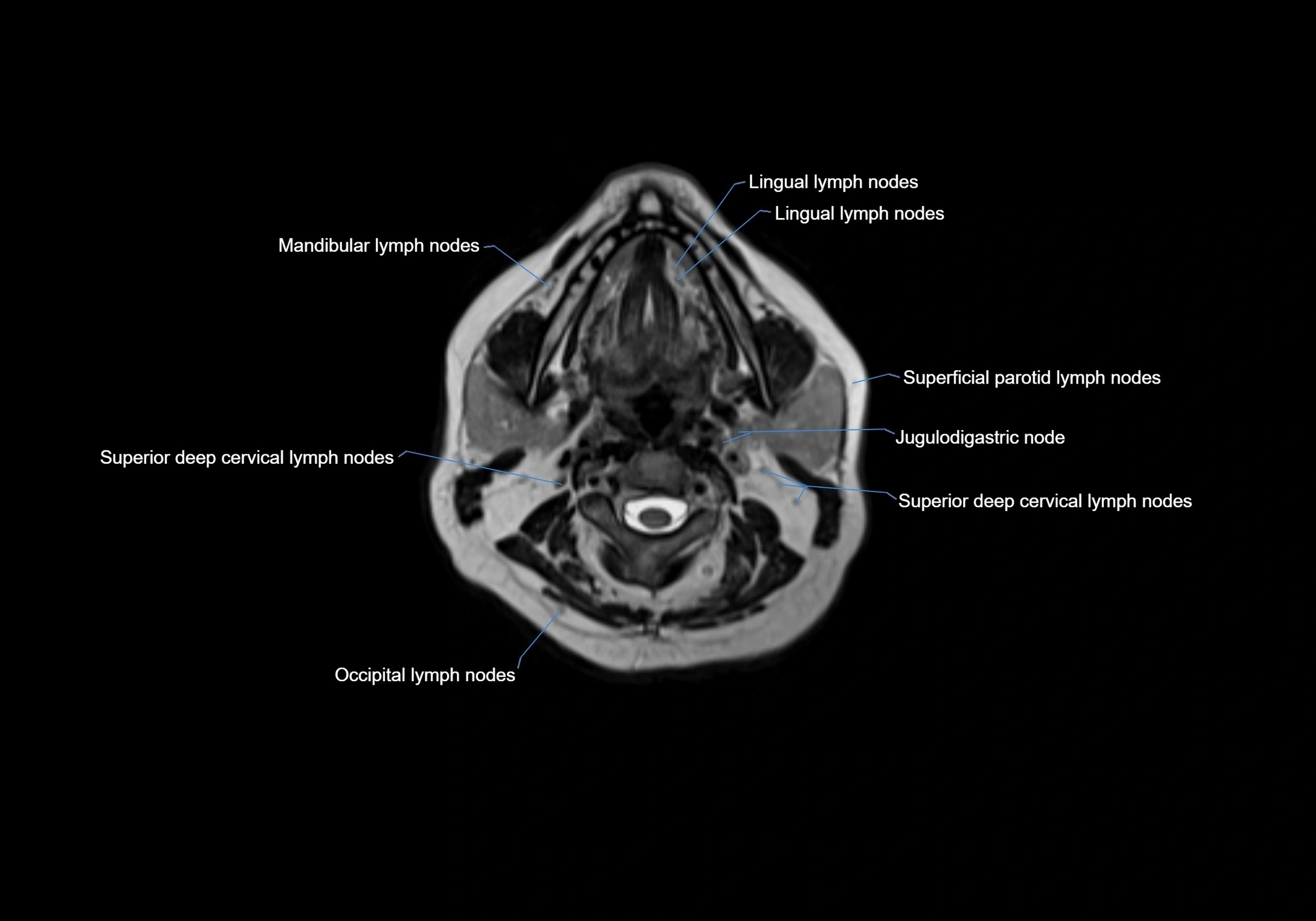 Neck axial  lymph node cross sectional MRI anatomy 3T MRI  image-img-00001-00044.webp